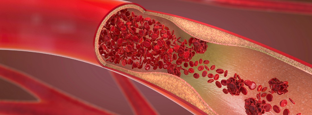 TCAR: A New Alternative for Treating Carotid Artery Disease