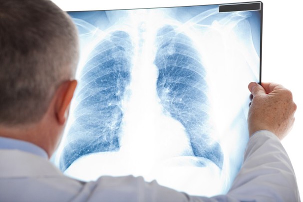 Lung Cancer Prevention And Detection